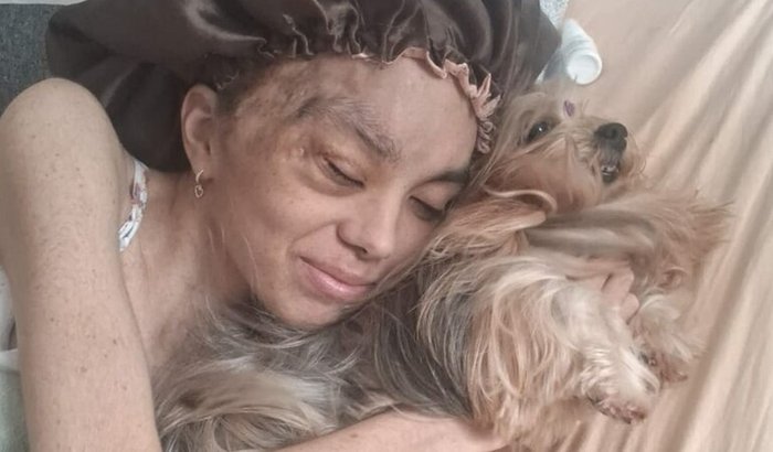 Compra de uma perna mecânica para Marina