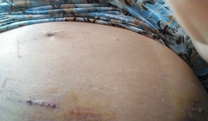 Acompanhamento médico, até a remoção da pele