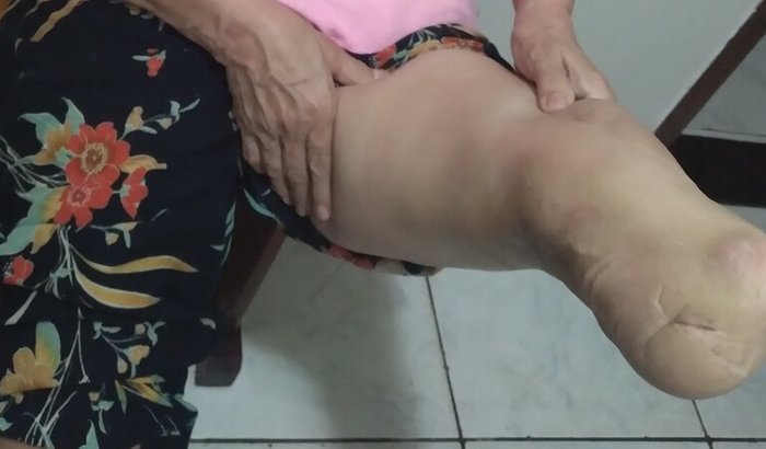 Prótese ortopédica