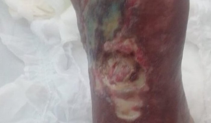 Meu pé está em risco- Ajude-me a Fazer a Cirurgia Urgente!