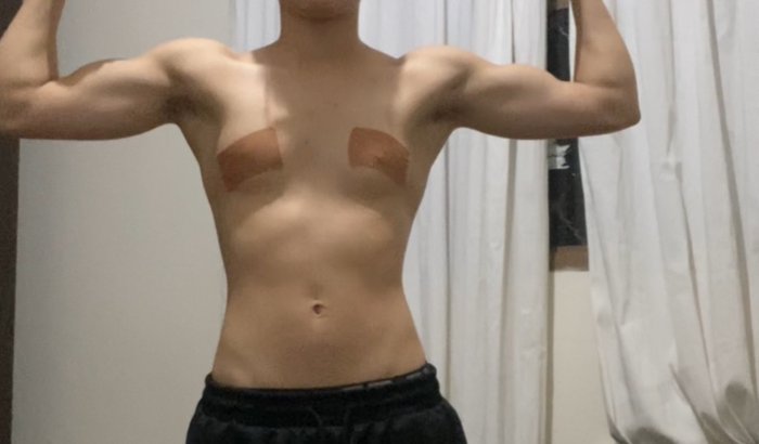 Mastectomia do Pedro