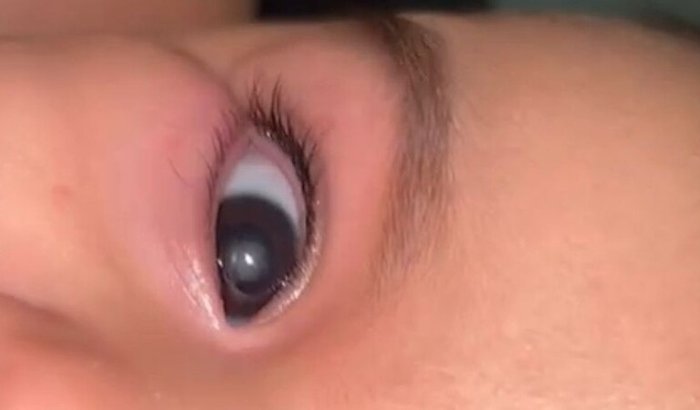 Cirurgia de catarata congênita