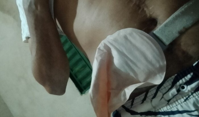 Ajuda a realizar minha cirurgia de retirada de bolsa de colostomia