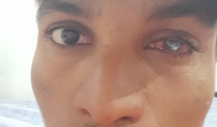 Procedimento cirúrgico transplante de córnea/medicamento 