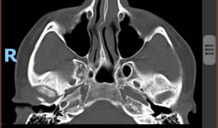 Cirurgia de fratura nasal da Hanne