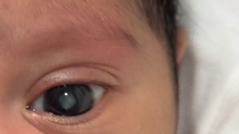 Ajude a Ágata enxergar melhor (cirurgia de catarata)