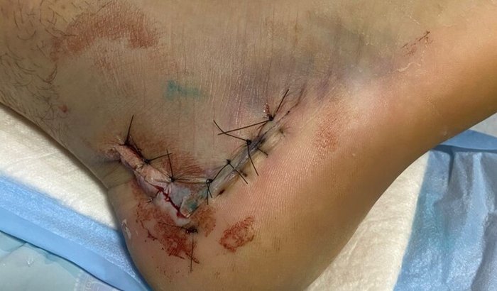 Ajudar o Francisco das Chagas acidente no elevador