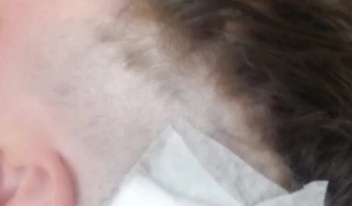 Tratamento da prof Jaque