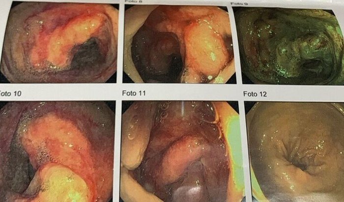 Colonoscopia e Biópsia. Cirurgia, remoção de um pólipo no intestino.