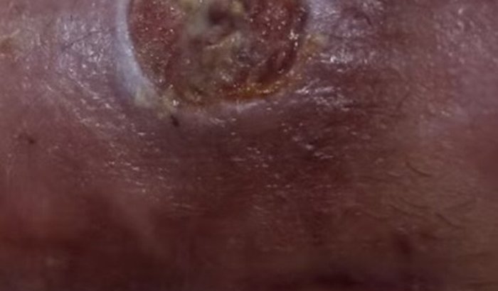 Ajuda o João a concluir o tratamento contra o câncer