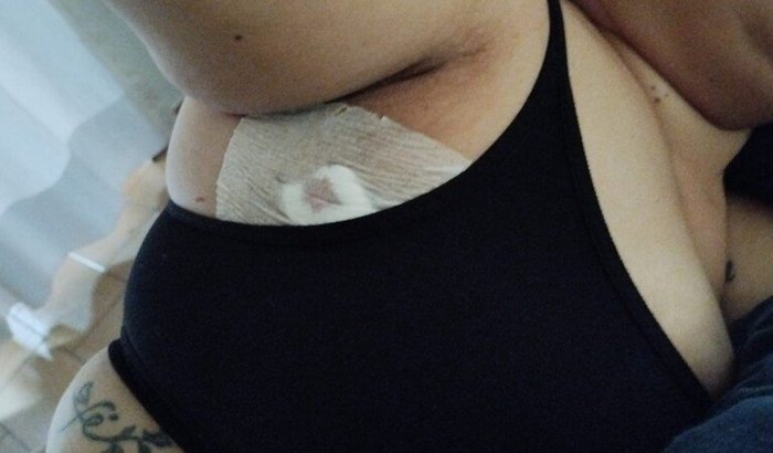 Efeitos colaterais do câncer (Drenagens, fisioterapia, hidroginástica, remédios e vitaminas e IMUNOTERAPIA)