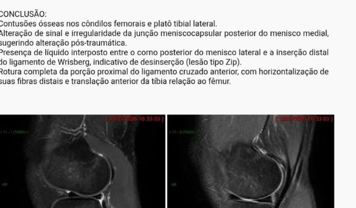 Custear Cirurgia e Tratamentos lesão LCA e Menisco
