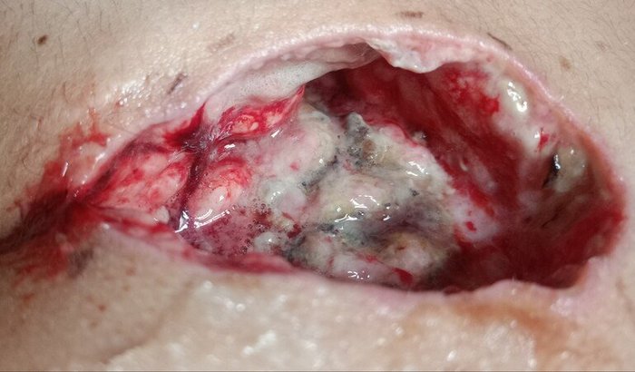 Cisto pelonidal