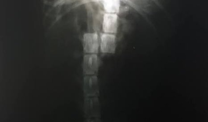 Cirurgia da Maya