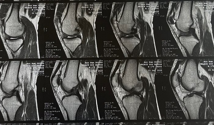 CIRURGIA ATLETA DE JIU JITSU WALACE DOS SANTOS