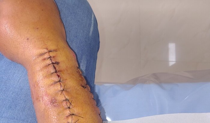 Ajuda voluntário pra mim que sofri um acidente de moto e estou passando por um pouco de dificuldade pra trabalhar 😢