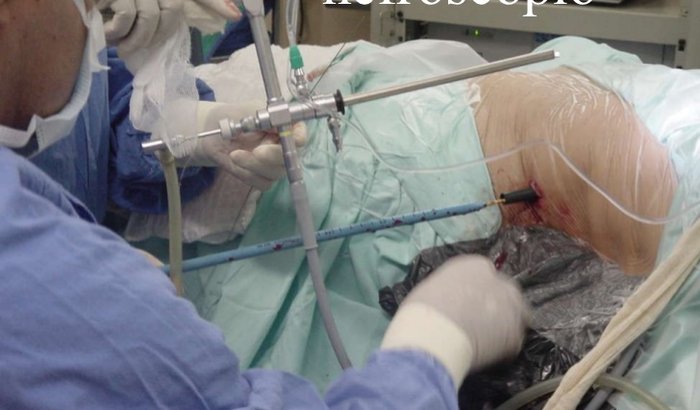 CIRURGIA NOS RINS nefrolitotripsia percutânea