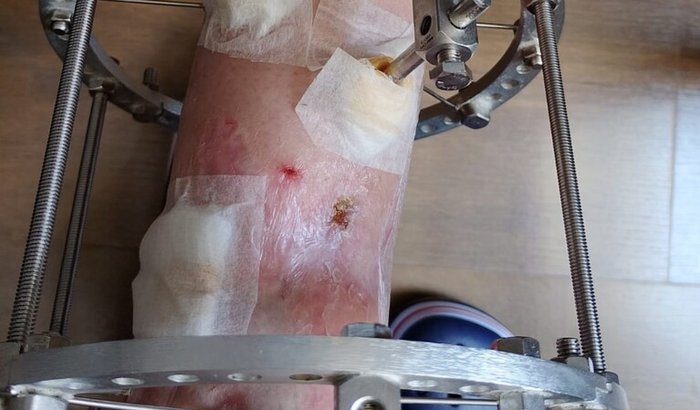 Ajude a Veri comprar uma prótese