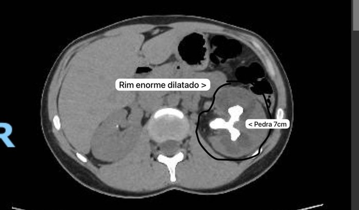 Cirurgia Urológica - Carol Henckel