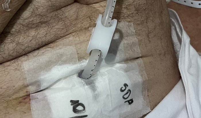 Alimentação Enteral do Meu Pai