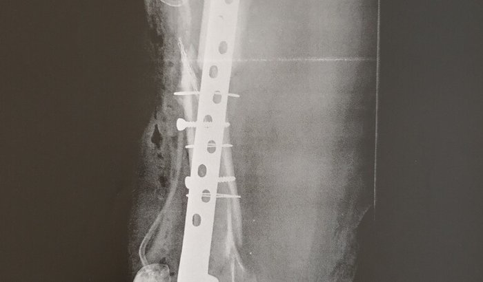 “Um carro na contramão mudou minha vida — ajude-me a salvar minha perna”