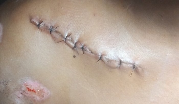 Corrente de loridariedade sobre meu acidente