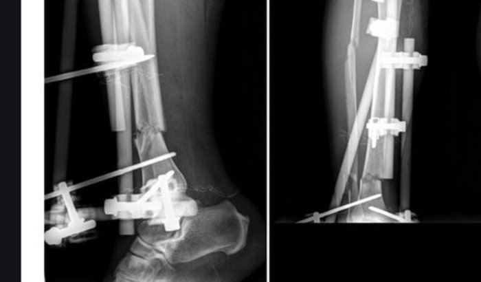 MOTOBOY FRATUROU A PERNA E NECESSITA DA SUA AJUDA