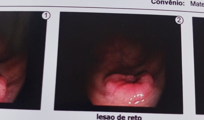 MUCOSECTOMIA