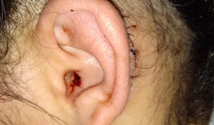 Ajude Da aniele na Cirurgia de um tumor (Tímpano-Mastoidectomia)