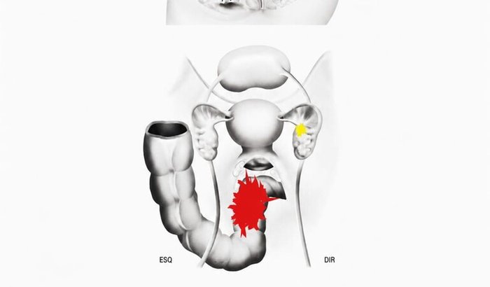 Todos pela Larissa: Endometriose comprometeu o intestino e precisa fazer uma cirurgia de urgência