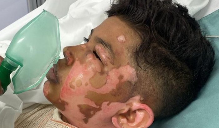ACIDENTE COM FOGO, AJUDE ESSA FAMÍLIA A RECOMEÇAR