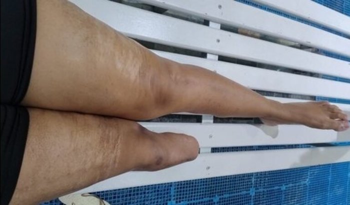 Andar sem dor