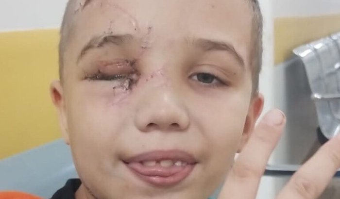 Ajudar um príncipe a tratar e recuperar a saúde do seu olhinho