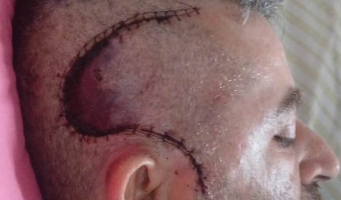 Tratamento Glioblastoma Grau 4 (Tumor Cerebral)