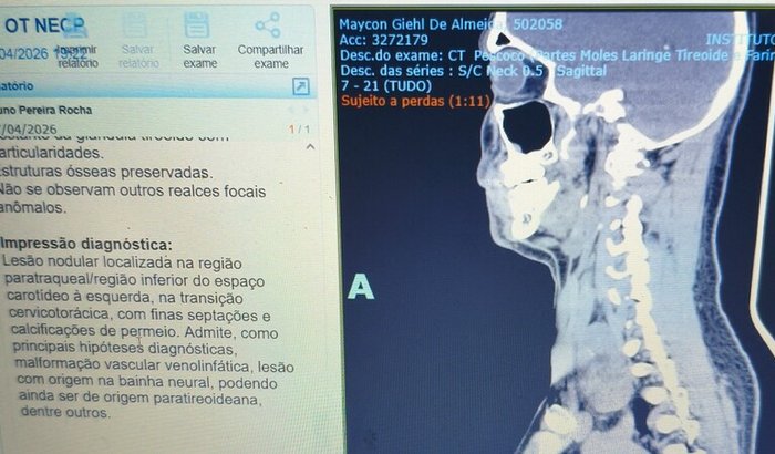 Cirurgia remoção de tumor no pescoço