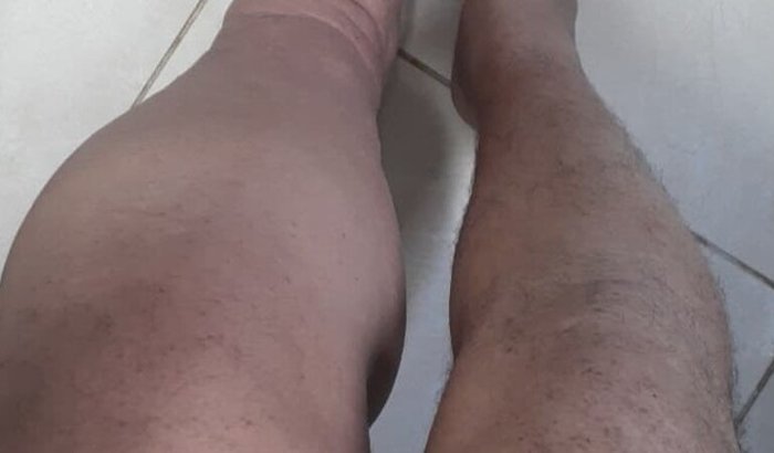 ❤️ Ajude o Juliano LostGamer: Exames e Tratamento do Linfedema
