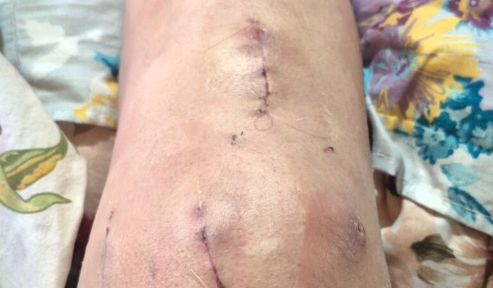 Cirurgia no joelho (osteotomia)