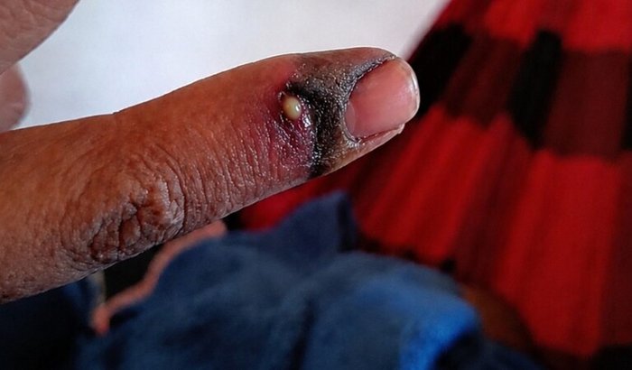 Paciente em seguimento clínico após acidente escorpiônico