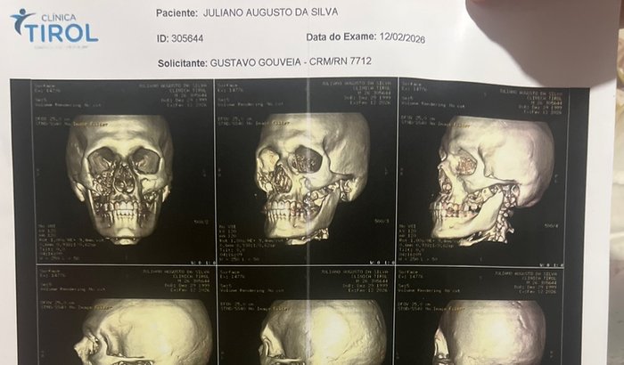 Próteses ocula e palato.