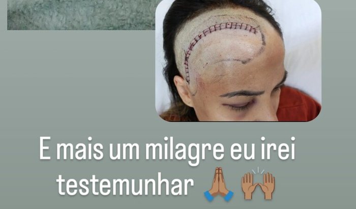 Ajuda para o tratamento de radioterapia devido um tumor na cabeça