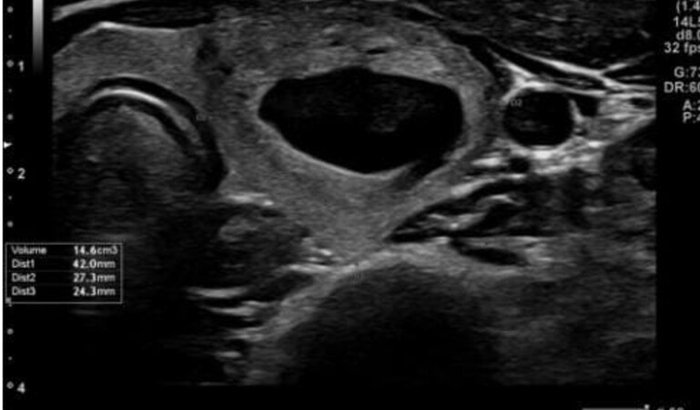 Cirurgia Urgente da Tireoide
