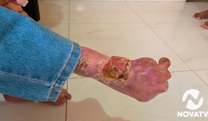 Jovens com epidermólise bolhosa em Lins