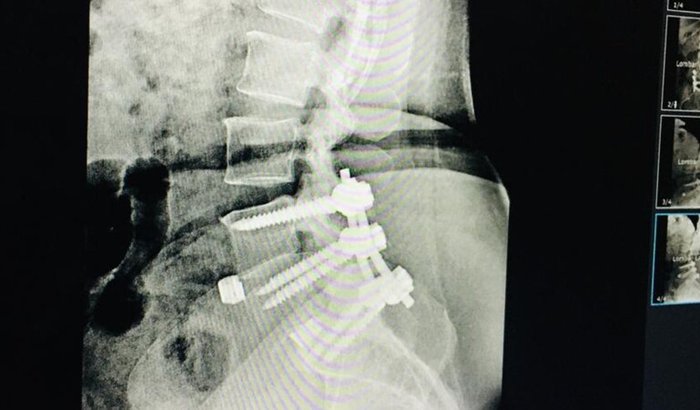 Vaquinha solidariedade para cirurgia na coluna que teve complicações
