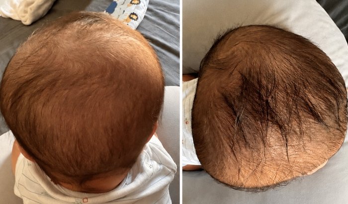 Contribuição para prótese craniana do Luke