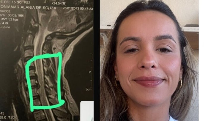 Cirurgia de descompressão cervical