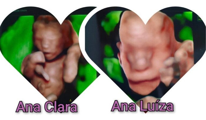 SOS Pelas Nossas Gêmeas Ana Clara e Ana Luíza