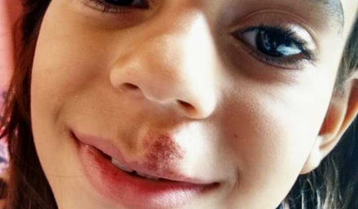 Ajude a pagar um especialista para tratar o Hemangioma 