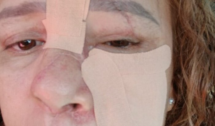Ajude Agda a continuar sua cirurgia reconstrutiva facial