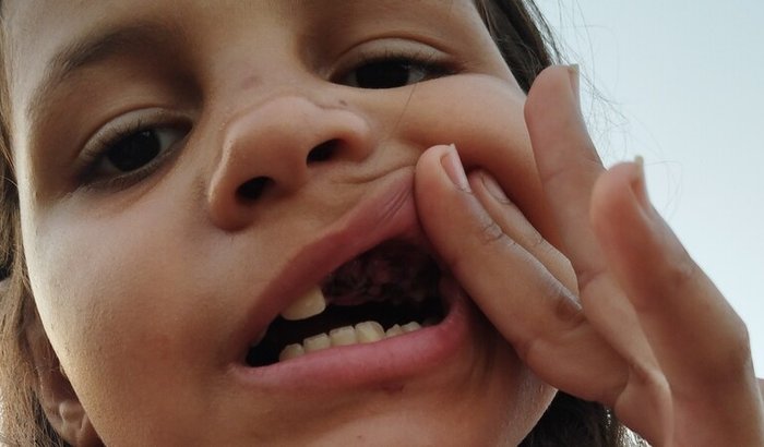 Ajuda para dentes provisório da Isis 10 anos