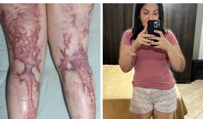 Ajuda no tratamento das queimaduras da Deisyane Barros
